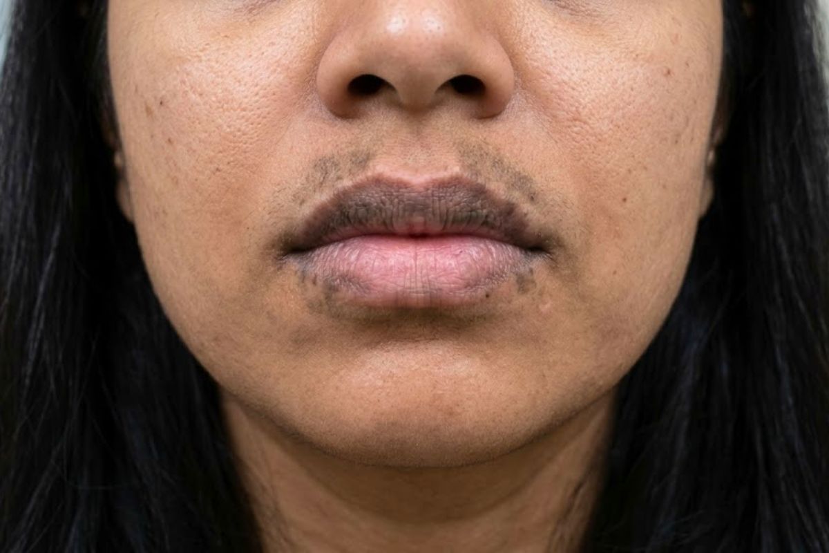 Before treatment